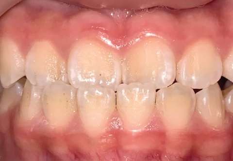 Bác sĩ tư vấn: Niềng răng có hết móm không?